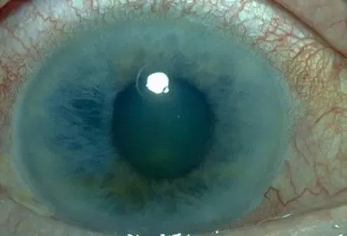 Glaucoma Treatment
