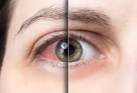 Ocular Surface Treatment